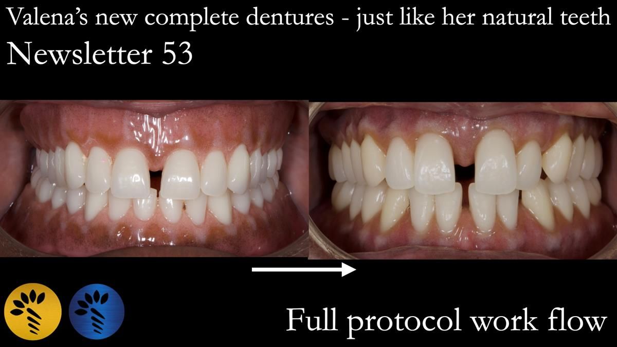 Newsletter 53 showing the making and fitting of ultra life-like dentures for Valena