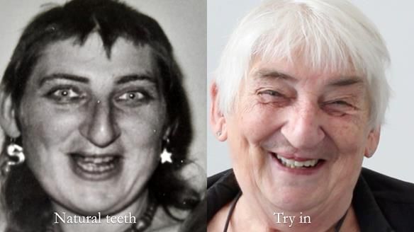 Newsletter 55 Provision of metal based partial dentures for Zephyrine with a repaired cleft lip and palate