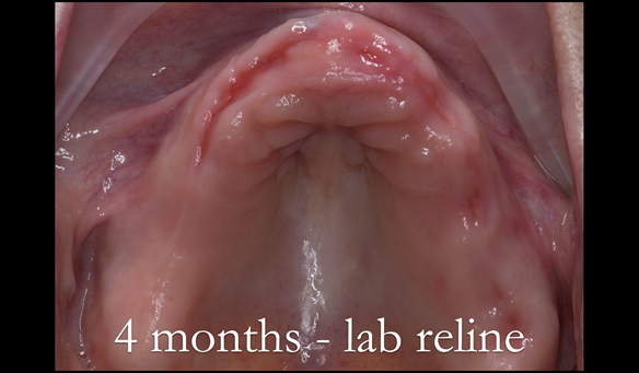 Figure 49 Resorption of the upper ridge at 4 months - laboratory reline indicated