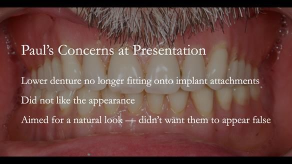 Newsletter 78: What do Clark Gable and a Locator® overdenture have in common?