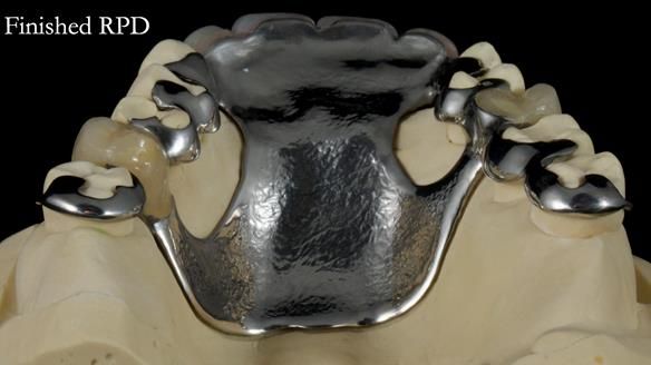 Newsletter 81 - Pam’s Story — how a partial denture changed her life (+ live walkthrough this Thursday)
