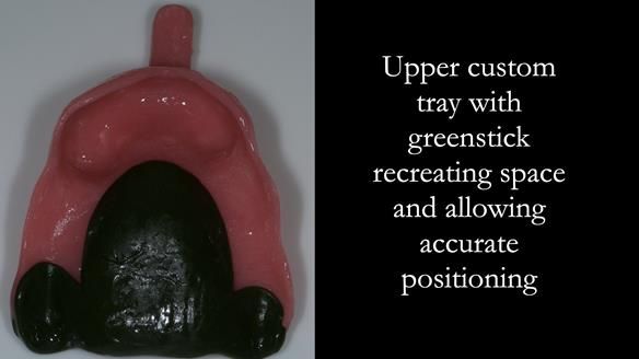 Finlay's Case Study Newsletter 40 - Immediate Mk 1 RPD to Definitive Mk 2 RPD - full protocol