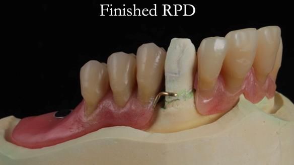 Finlay's Newsletter 59 Ultra hard partial dentures made for Gill