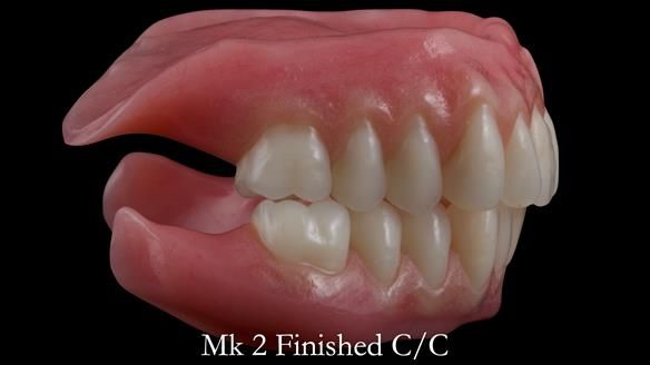 Replacing Madeline’s Complete denture FULL PROTOCOL