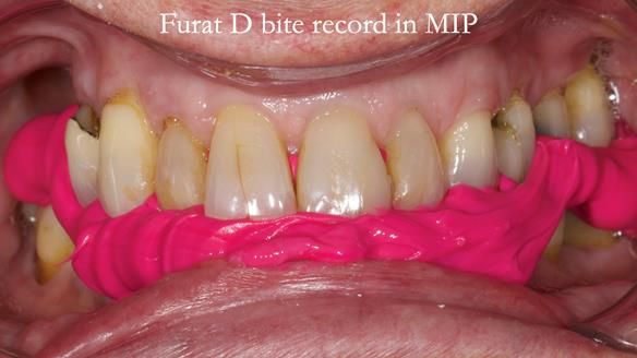 Finlay's Newsletter 64 case study - provision of a Kennedy class 2 metal based Scandinavian RPD for Ian