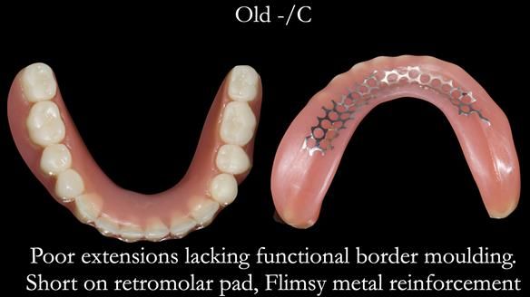 Newsletter 50 Special edition Complete Dentures FULL PROTOCOL