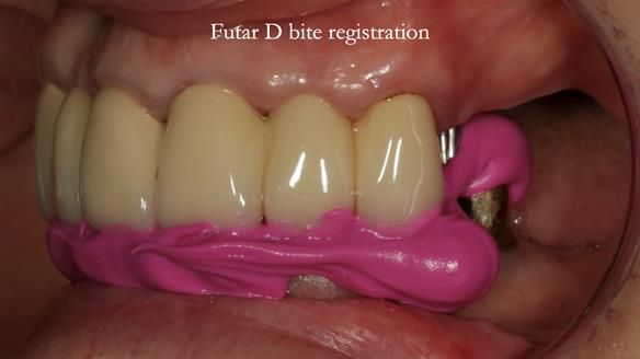 Newsletter 76: Jackie’s case – Telescopic overdenture & precision RPD (the tricky truth!)