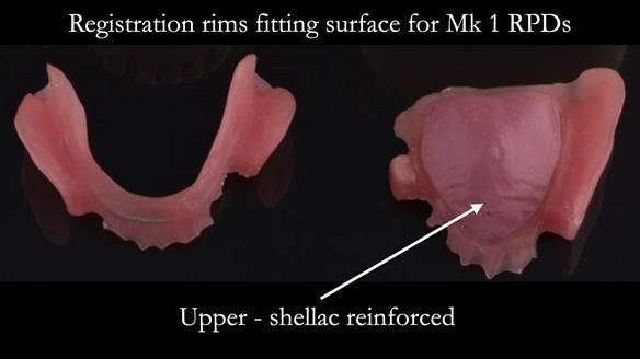 Finlay's Case Study Newsletter 40 - Immediate Mk 1 RPD to Definitive Mk 2 RPD - full protocol