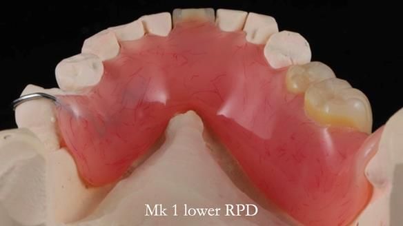 Newsletter 54 case presentation upper complete denture and lower Scandinavian designed hygienic partial denture for David