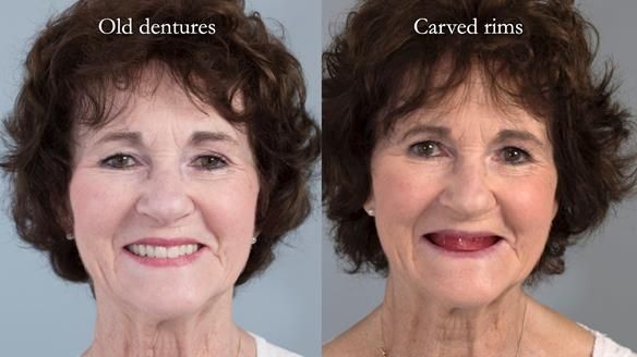 Newsletter 75: Marion’s case - Step-by-step complete denture workflow