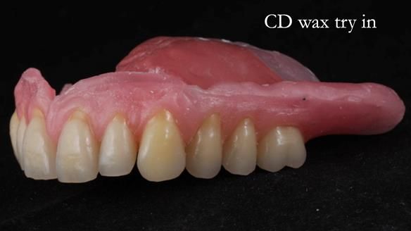 Finlay's Newsletter 62 provision of extractions and metal based complete dentures for Rafique