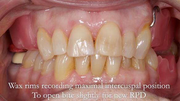 Finlay's Newsletter 60 Sylvia's upper Kennedy Class 2 Mod 1 metal based upper RPD