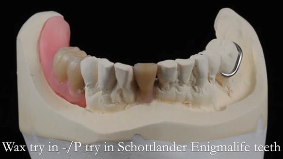 Newsletter 54 case presentation upper complete denture and lower Scandinavian designed hygienic partial denture for David