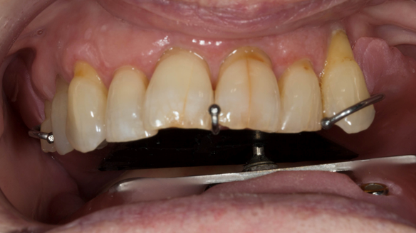 Figure 20 Registration visit with central bearing apparatus (gothic arch tracing) for CR recording moving to the patient's left