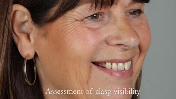 Newsletter 56 showing the making and fitting of a bilateral free end saddle upper removable partial denture (RPD) for patient with pemphigus