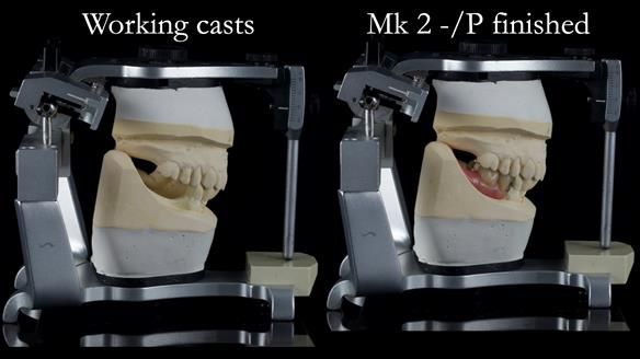 Newsletter 54 case presentation upper complete denture and lower Scandinavian designed hygienic partial denture for David