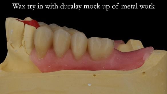 Finlay's Case Study Newsletter 40 - Immediate Mk 1 RPD to Definitive Mk 2 RPD - full protocol