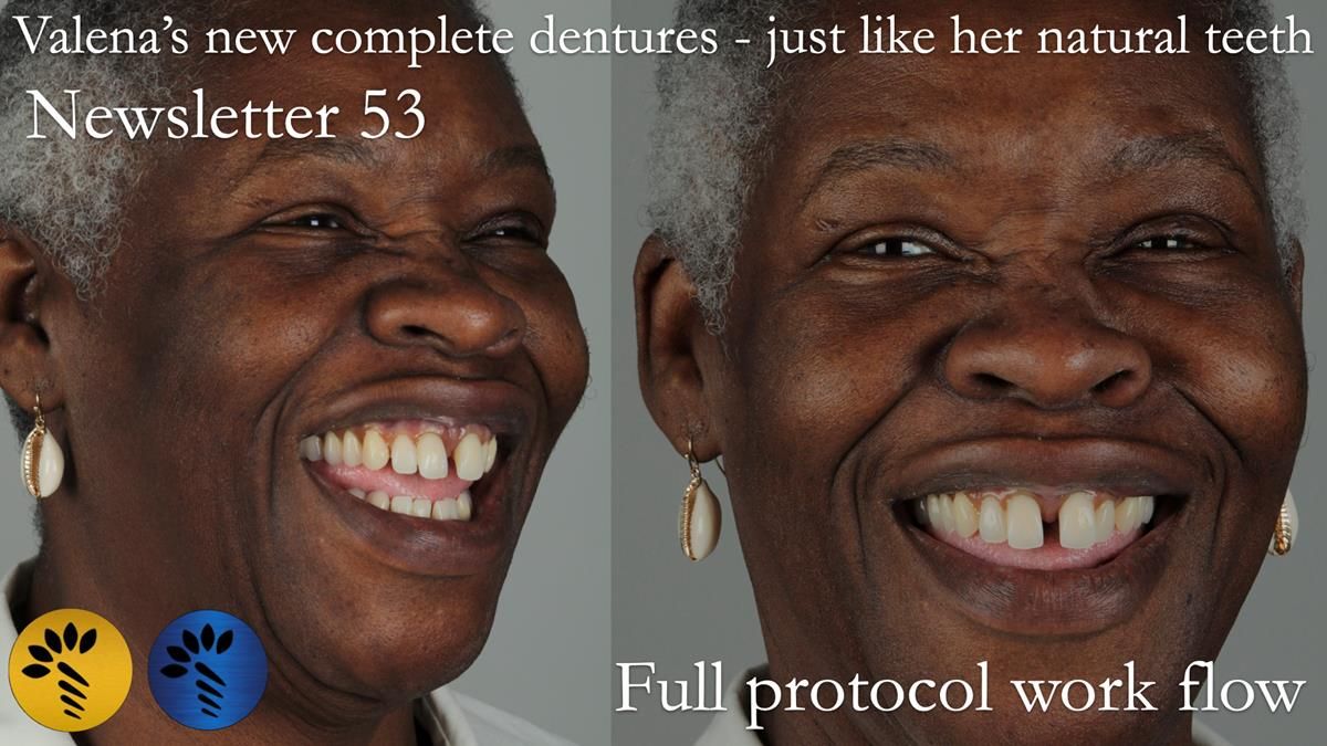 Newsletter 53 showing the making and fitting of ultra life-like dentures for Valena