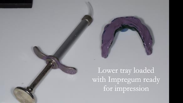 Newsletter 57 showcases the making and fitting process of implant-supported complete dentures for Alisdair