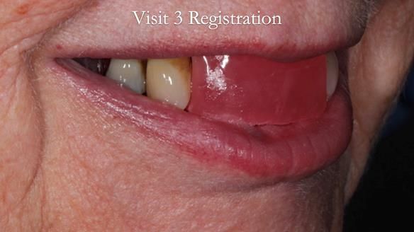 Finlay's Newsletter 59 Ultra hard partial dentures made for Gill