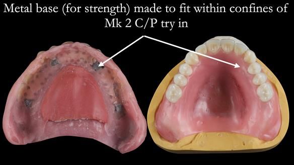 Newsletter 52 Managing Jo’s failing dentition with extractions and Mk 1/Mk 2 complete upper dentures and lower partial dentures FULL PROTOCOL