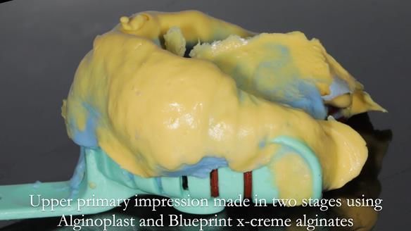 Newsletter 56 showing the making and fitting of a bilateral free end saddle upper removable partial denture (RPD) for patient with pemphigus