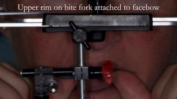 Newsletter 52 Managing Jo’s failing dentition with extractions and Mk 1/Mk 2 complete upper dentures and lower partial dentures FULL PROTOCOL