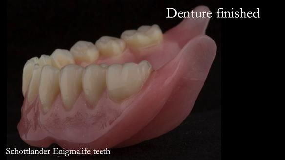 Newsletter 75: Marion’s case - Step-by-step complete denture workflow
