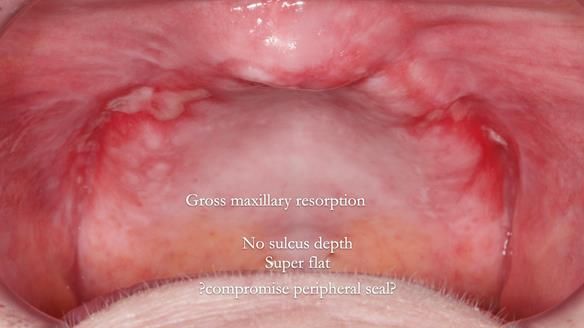 Replacing Madeline’s Complete denture FULL PROTOCOL