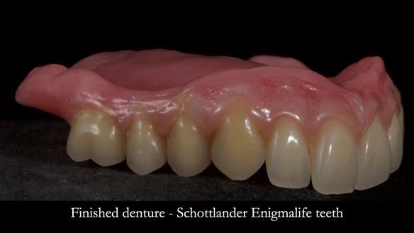 Newsletter 83: Sheila’s Complete Denture Success