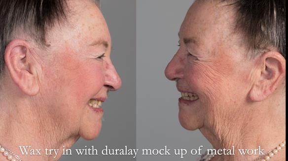 Finlay's Case Study Newsletter 40 - Immediate Mk 1 RPD to Definitive Mk 2 RPD - full protocol