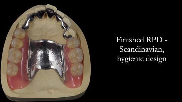 Newsletter 56 showing the making and fitting of a bilateral free end saddle upper removable partial denture (RPD) for patient with pemphigus