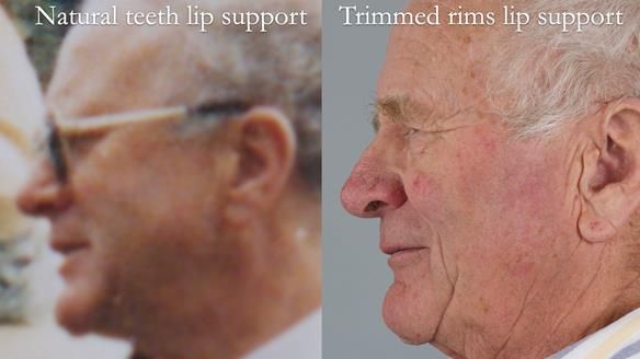 Complete denture Class II div 2 deep overbite Newsletter 39