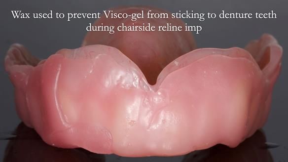 Newsletter 77: Jeremy’s case – immediate complete upper denture