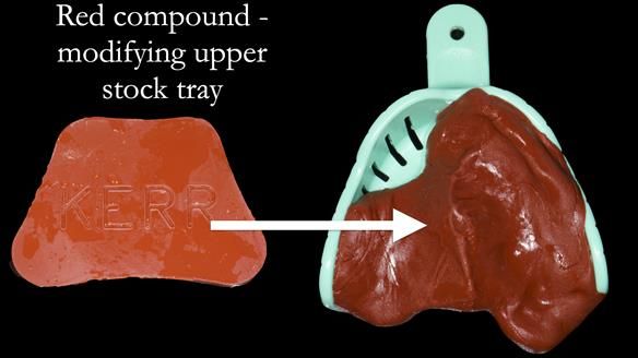 Newsletter 55 Provision of metal based partial dentures for Zephyrine with a repaired cleft lip and palate