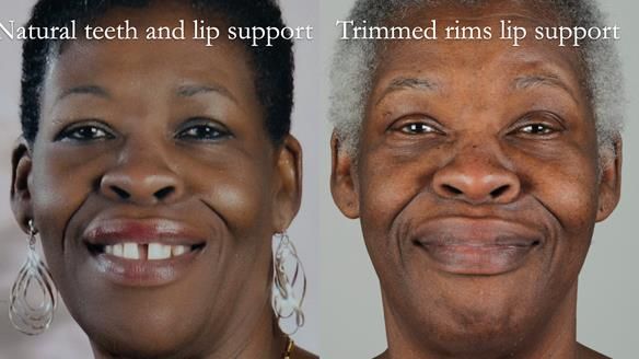 Newsletter 53 showing the making and fitting of ultra life-like dentures for Valena