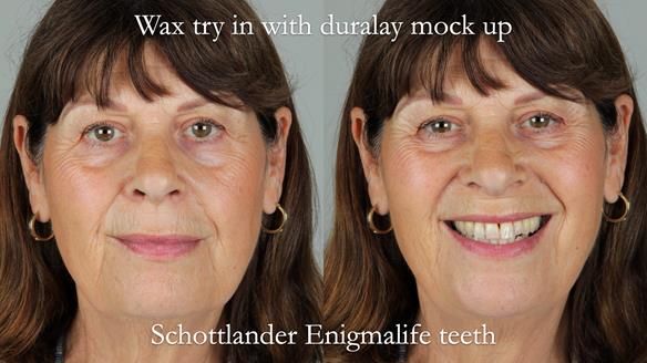 Newsletter 56 showing the making and fitting of a bilateral free end saddle upper removable partial denture (RPD) for patient with pemphigus