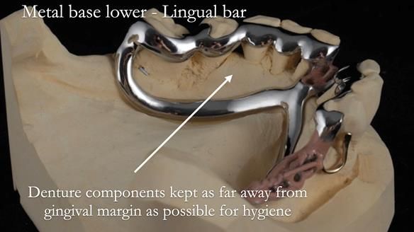 Newsletter 54 case presentation upper complete denture and lower Scandinavian designed hygienic partial denture for David
