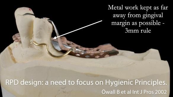 Finlay's Newsletter 59 Ultra hard partial dentures made for Gill