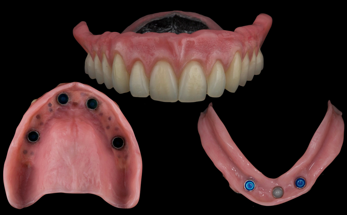 Difficult class III Lower complete metal based denture supported by dental implants and upper complete metal based denture - full protocol