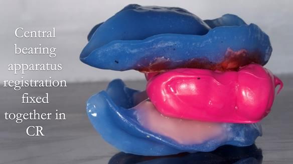 Newsletter 57 showcases the making and fitting process of implant-supported complete dentures for Alisdair