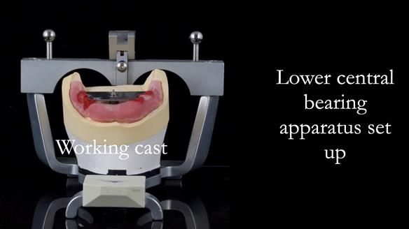 Newsletter 44 - extreme removable prosthodontics – engineering a super-strong and ultra-thin over denture