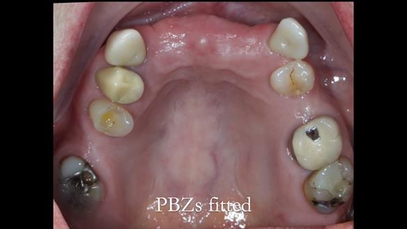 Newsletter 81 - Pam’s Story — how a partial denture changed her life (+ live walkthrough this Thursday)