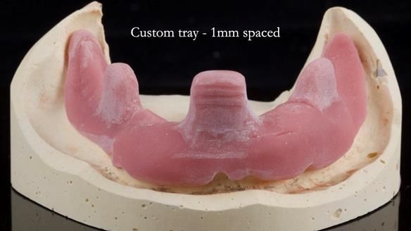 Newsletter 44 - extreme removable prosthodontics – engineering a super-strong and ultra-thin over denture