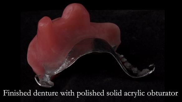 Upper metal base partial denture/occlusal stabilisation splint/obturator - full protocol