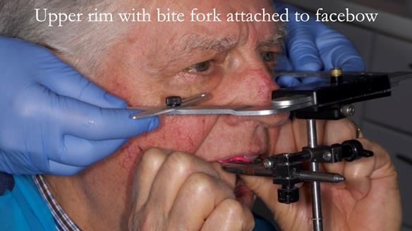 Finlay's Newsletter 64 case study - provision of a Kennedy class 2 metal based Scandinavian RPD for Ian