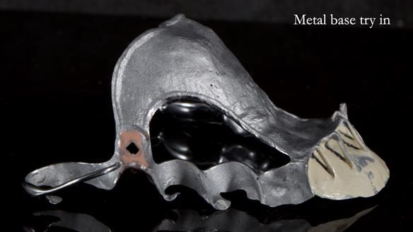 Newsletter 81 - Pam’s Story — how a partial denture changed her life (+ live walkthrough this Thursday)