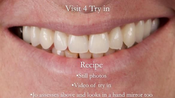 Newsletter 52 Managing Jo’s failing dentition with extractions and Mk 1/Mk 2 complete upper dentures and lower partial dentures FULL PROTOCOL