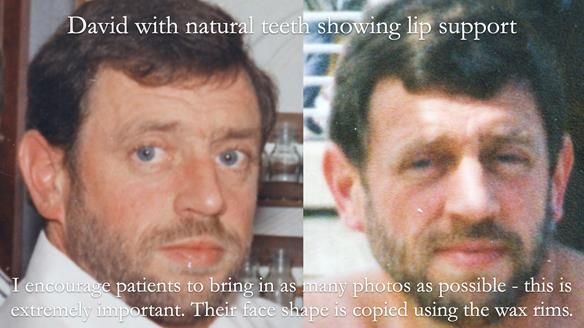 Newsletter 54 case presentation upper complete denture and lower Scandinavian designed hygienic partial denture for David