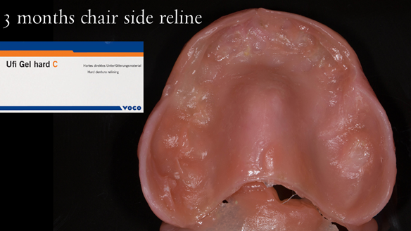 Figure 54 3 months post extraction. Mk 1 reline of intaglio surface with Ufi Gel Hard.